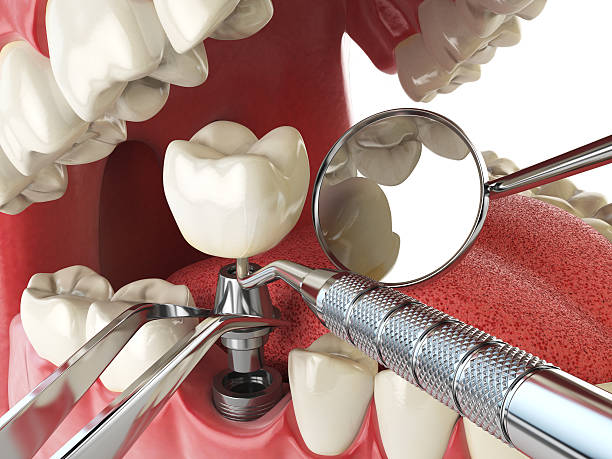 Best Broken or Chipped Tooth Repair in Stanford, KY